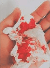 anal-bleeding-1-e1727970019311.png anal-bleeding-1-e1727970019311.png